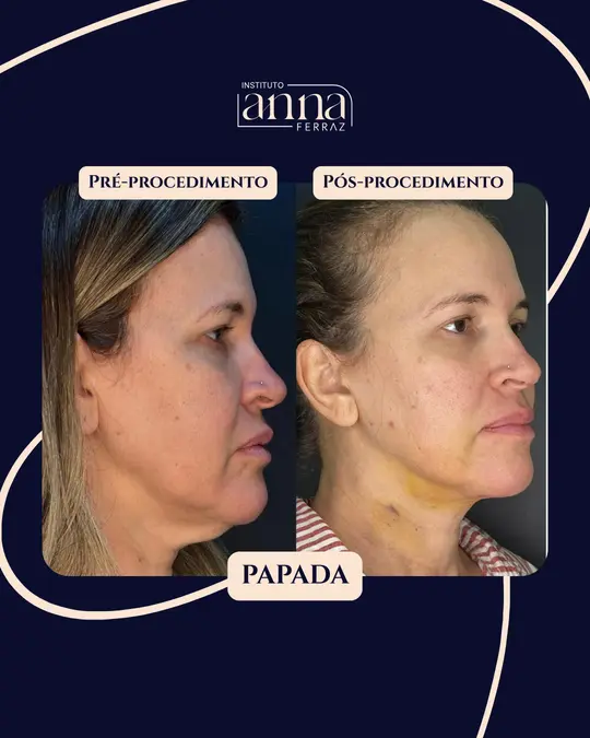 Antes e depois de harmonização orofacial — Papada, resultado real no Instituto Anna Ferraz, São Paulo